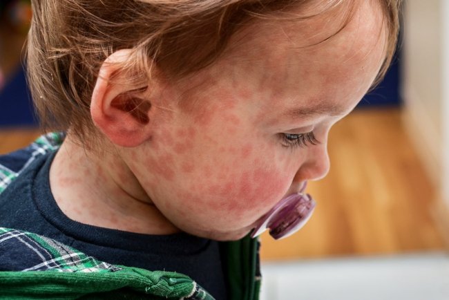 Think Your Baby Might Be Allergic to Cow’s Milk? Here’s What Parents Need to Know