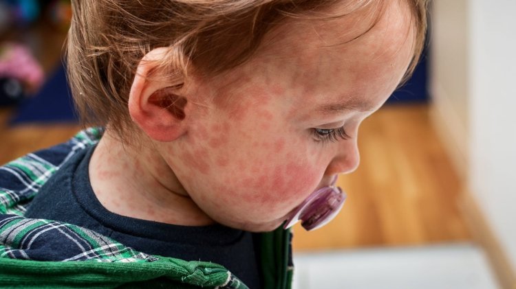 Think Your Baby Might Be Allergic to Cow’s Milk? Here’s What Parents Need to Know